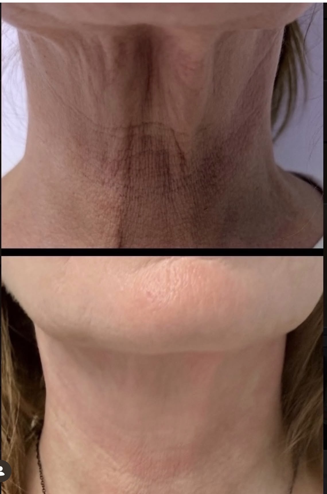 Results after 3 neck treatments