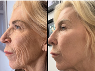 Jet Plasma T33 before and after – 4 face sessions