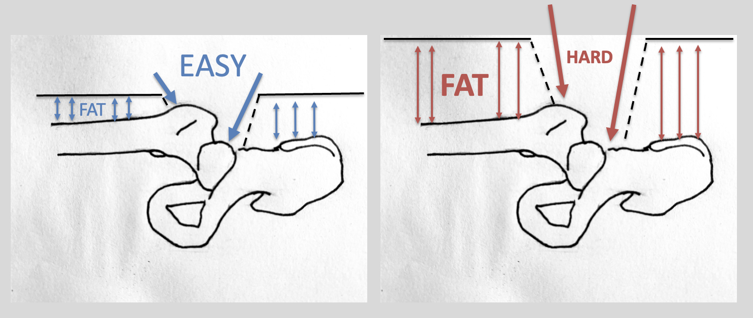 Operating through fat is HARD