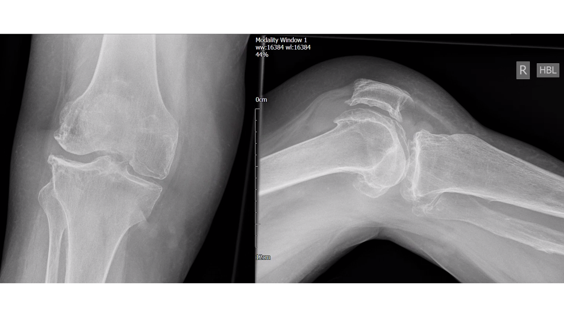 An X-ray film of Knee Osteoarthritis