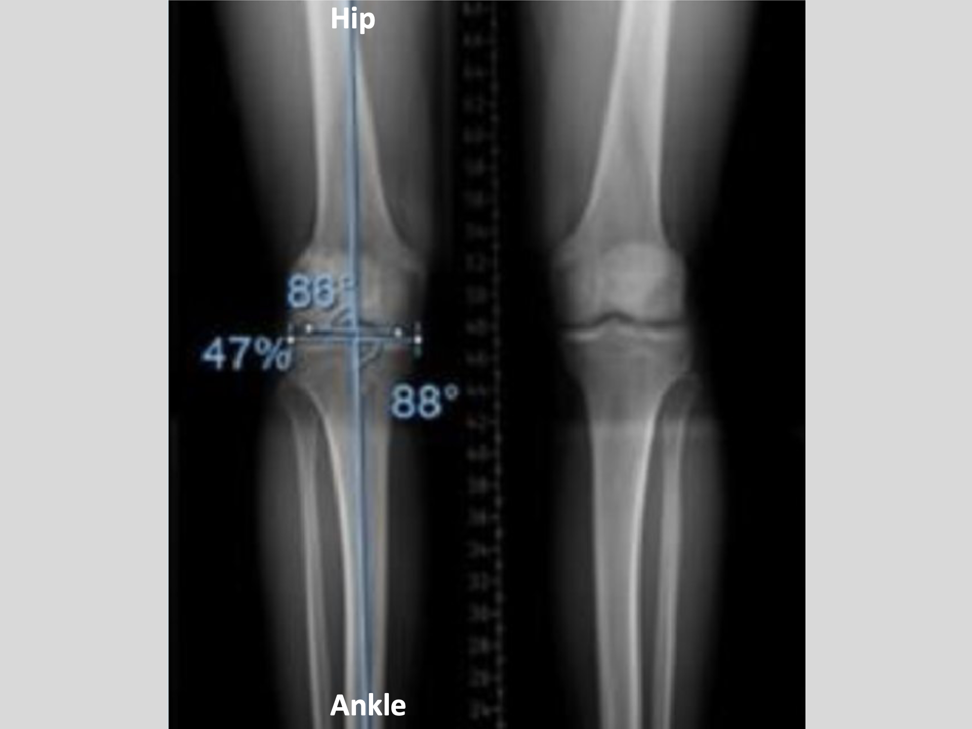 Long leg alignment X-ray film