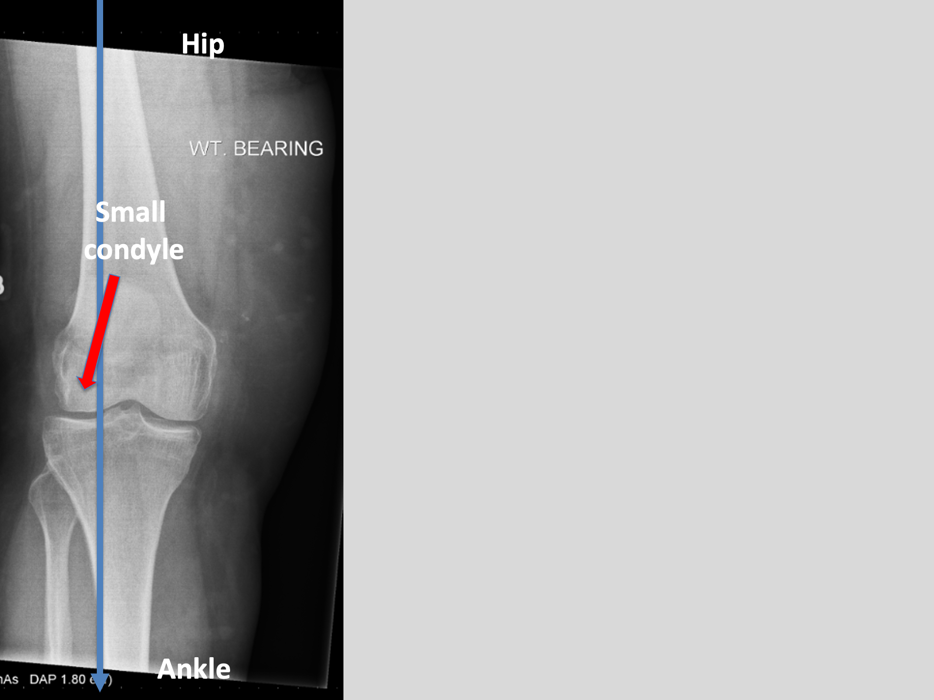 Long leg alignment X-ray film