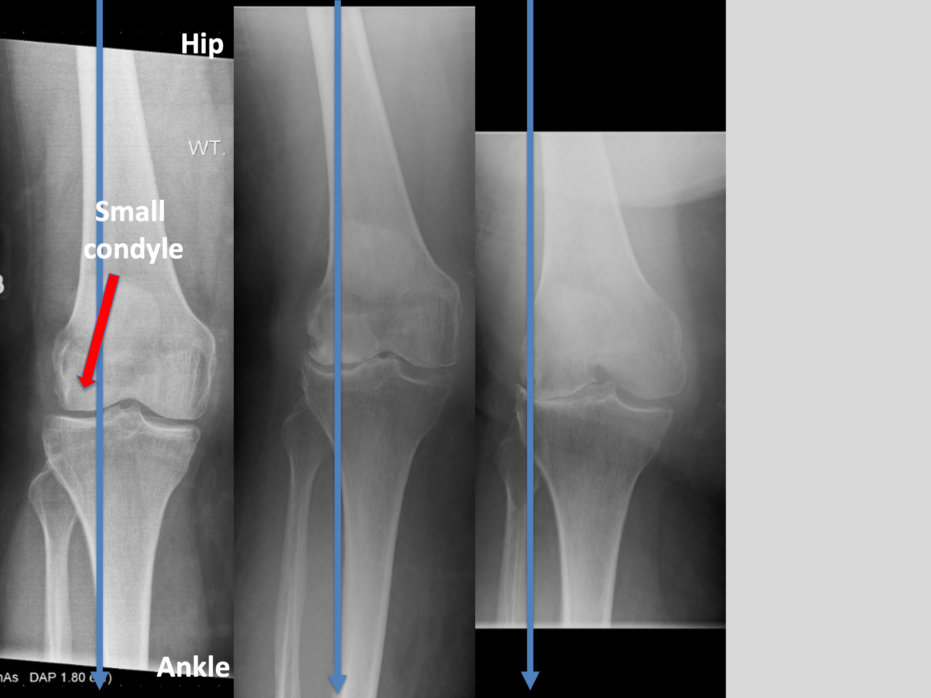 Long leg alignment X-ray film lateral OA knee