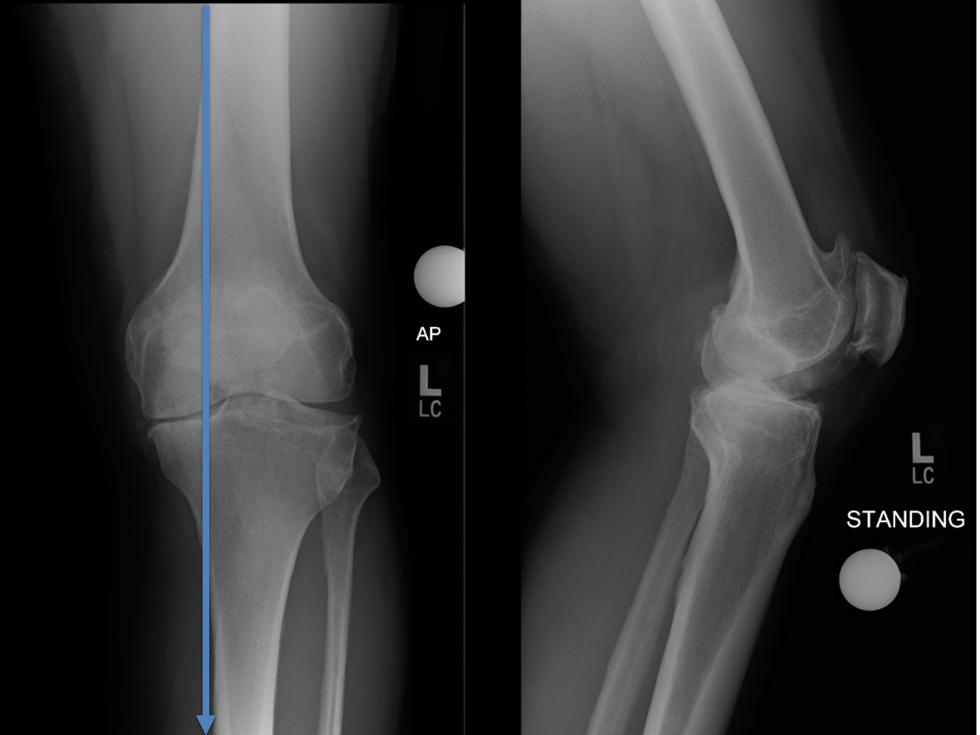 Long leg alignment X-ray film