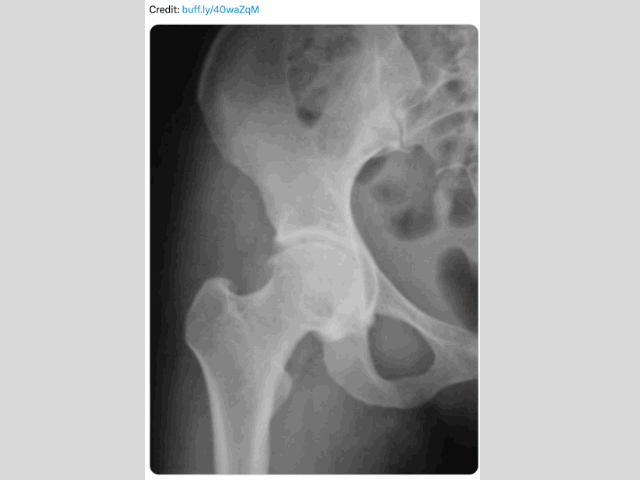 Cause of Hip Osteoarthritis